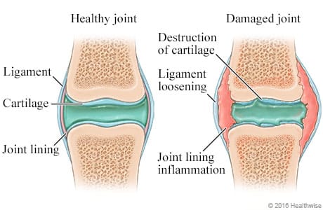 Rebuilding Cartilage Is Possible — If You Understand the Biology